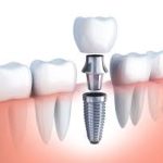 Navigating the Myths and Realities of Dental Implants